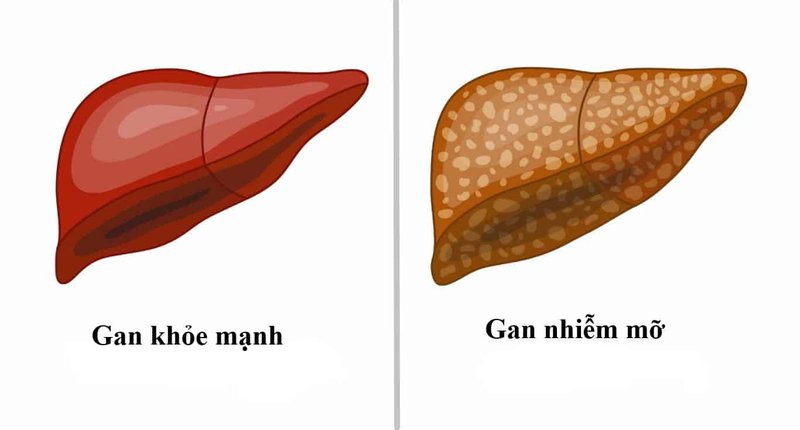 Hiện không có biện pháp đặc trị gan nhiễm mỡ